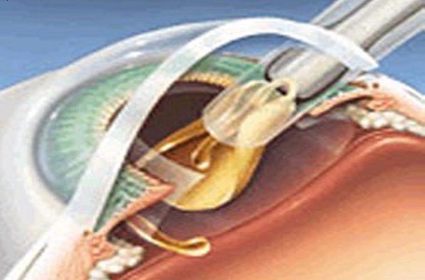 No Intraocular Lens (IOL) Implants at GB Pant Hospital; Suffering continues for patients